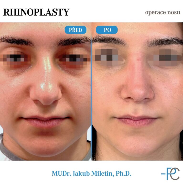PGA rhinoplasty