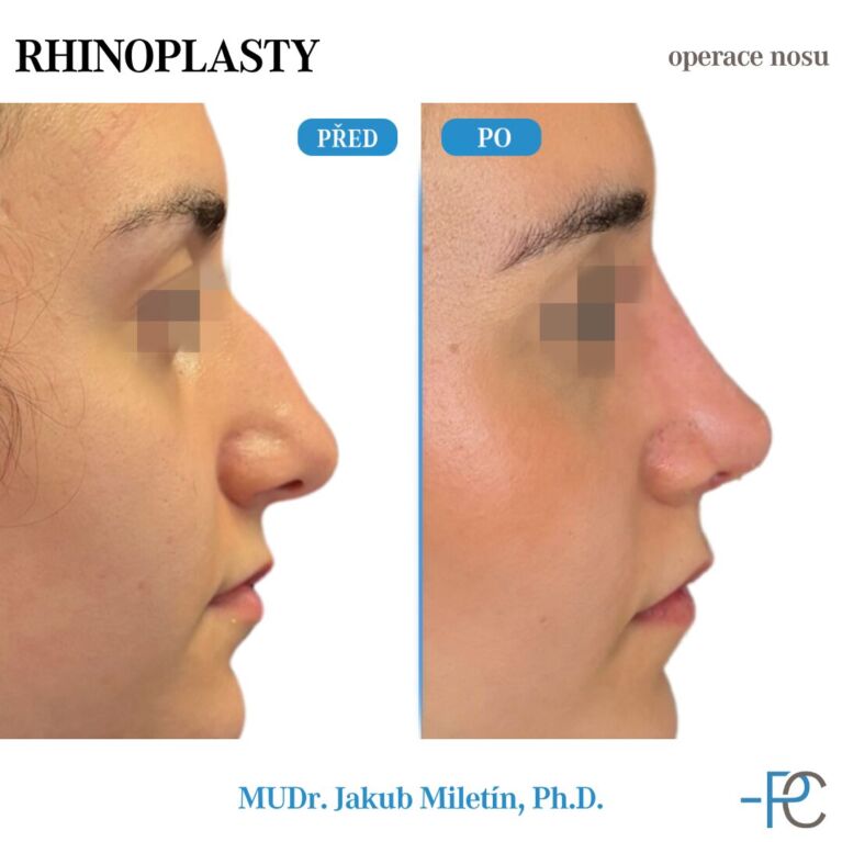 PGA rhinoplasty