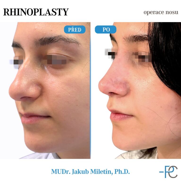 PGA rhinoplasty