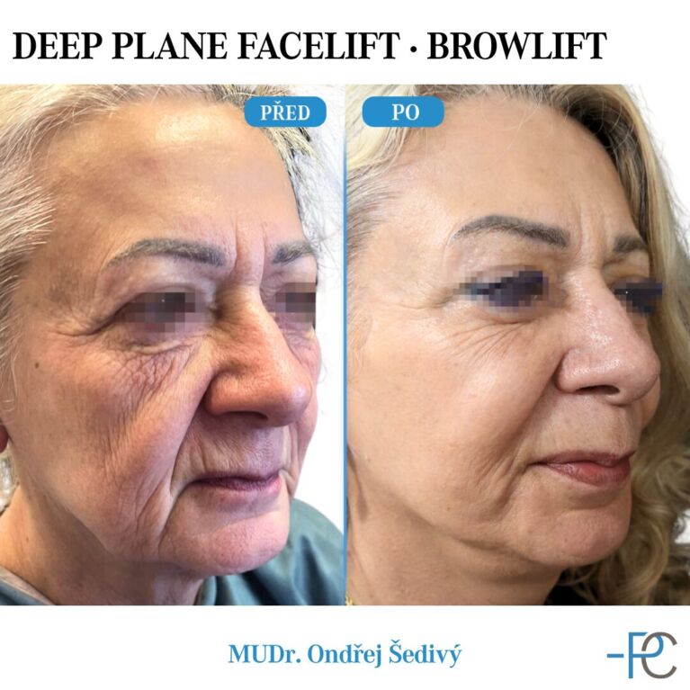 Deep Plane Facelift • Browlift
