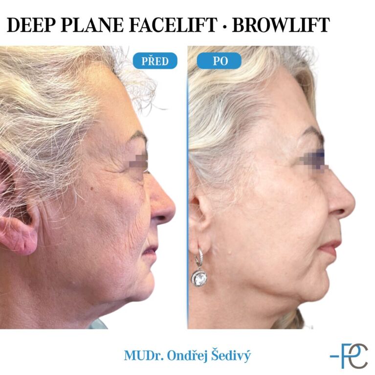 Deep Plane Facelift • Browlift