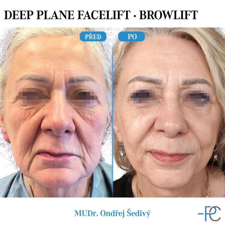 Deep Plane Facelift • Browlift