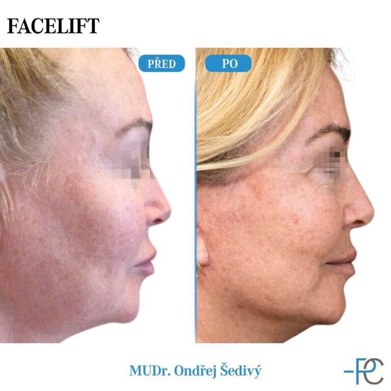 Facelift