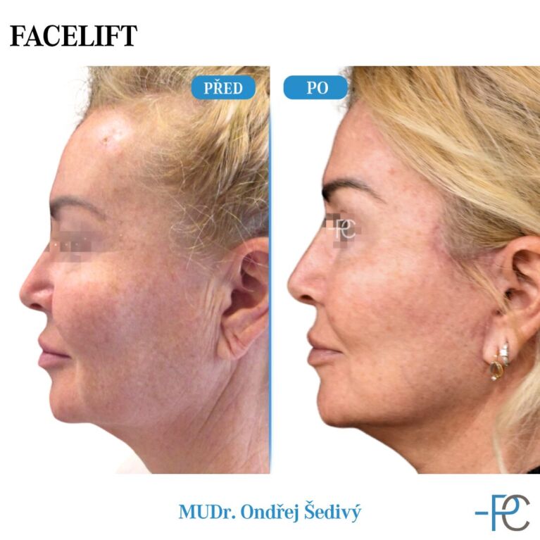 Facelift
