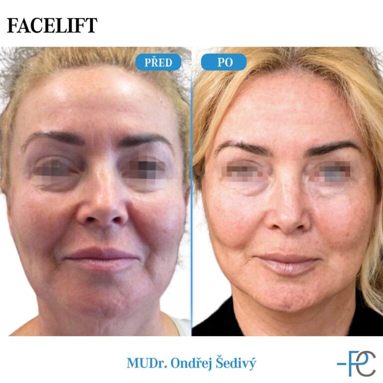 Facelift