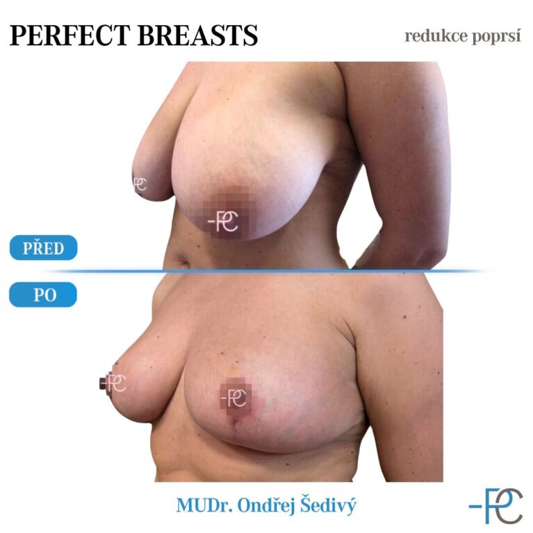 Breast reduction