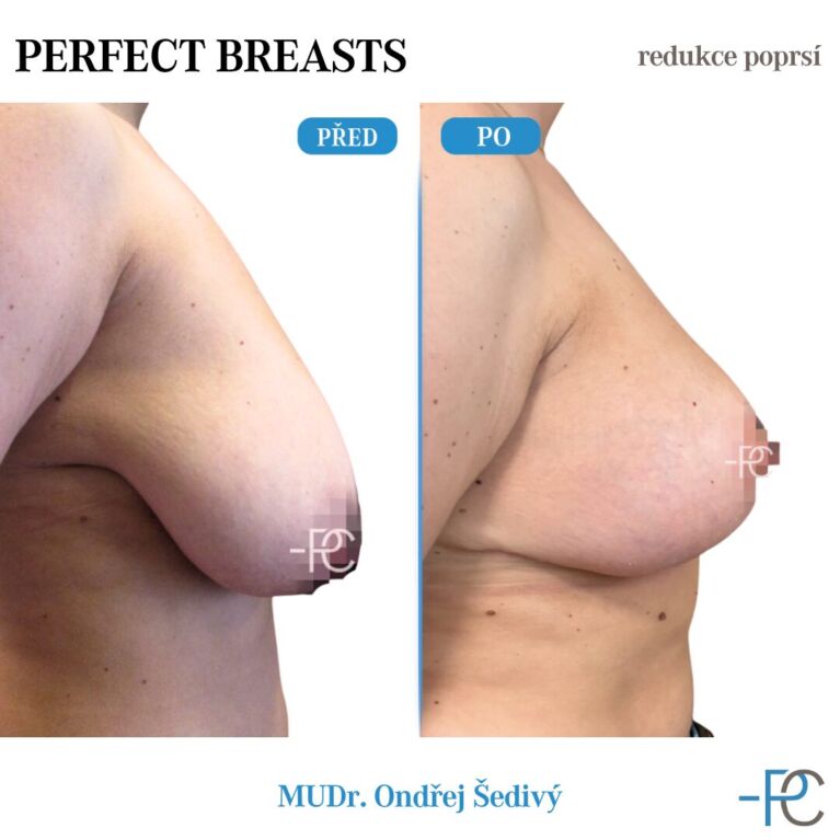 Breast reduction
