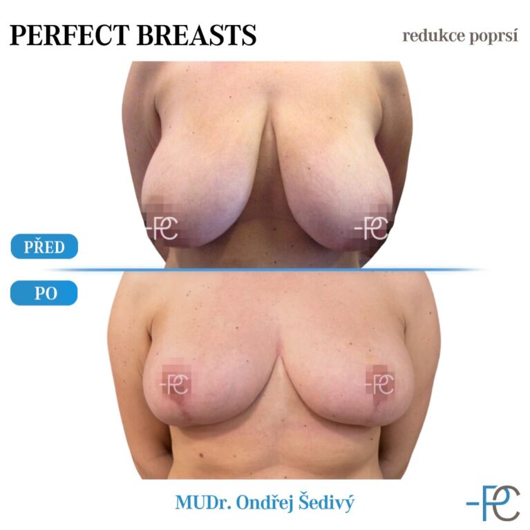 Breast reduction