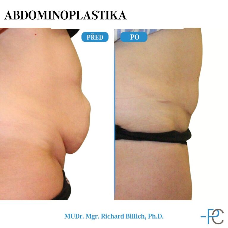 Abdominoplastika