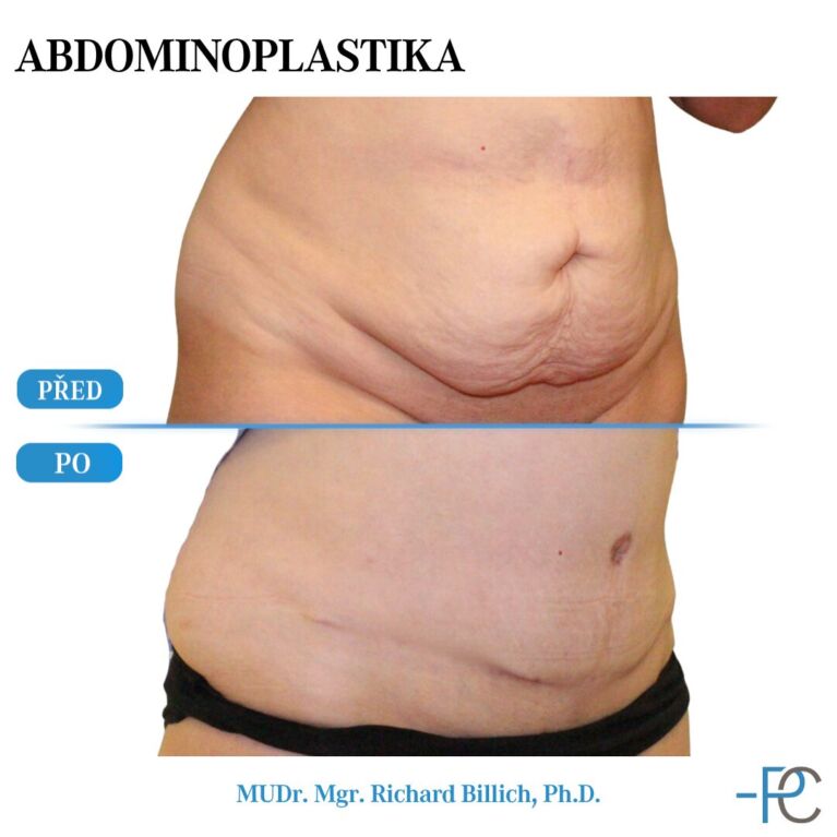 Abdominoplastika