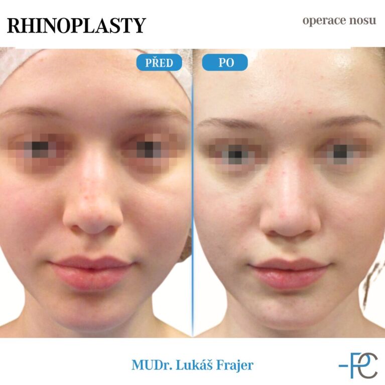 Rhinoplastika
