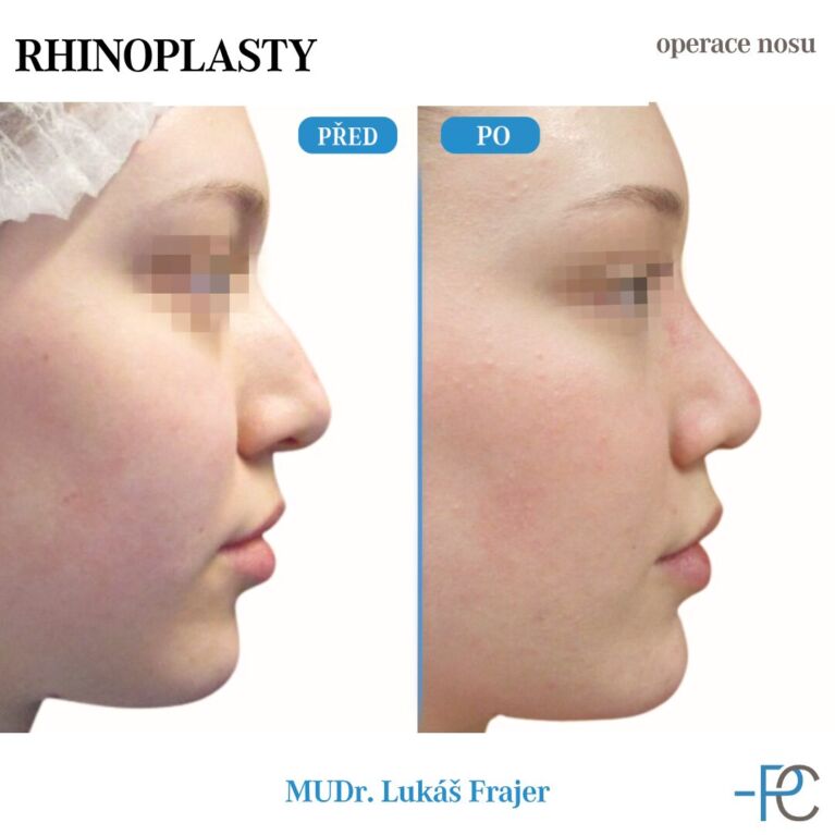 Rhinoplastika