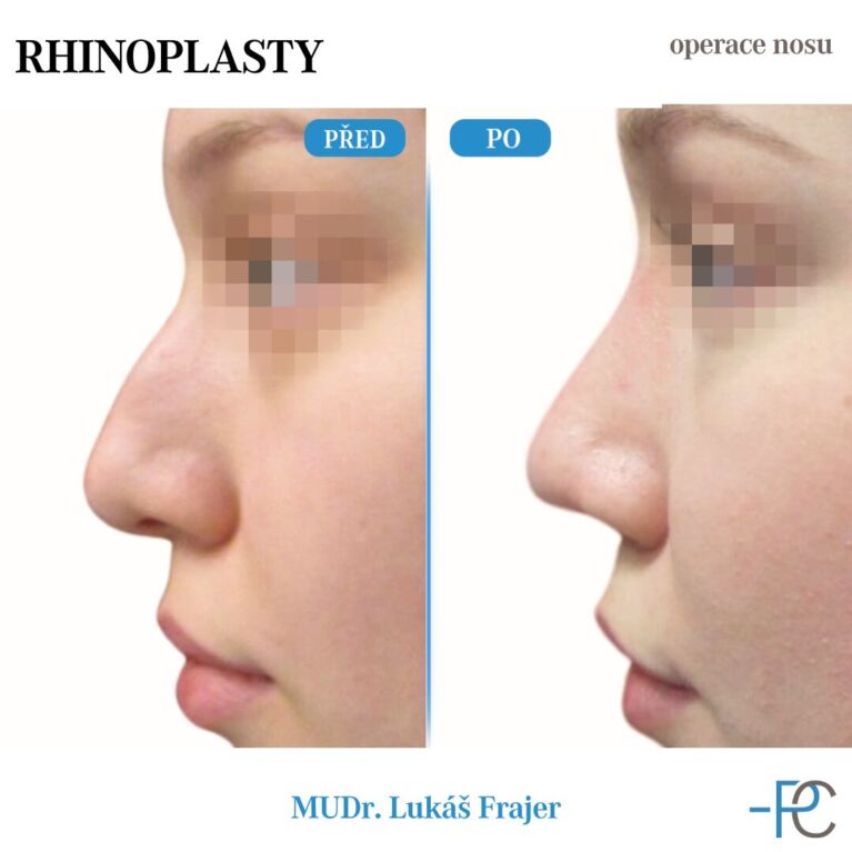 Rhinoplastika
