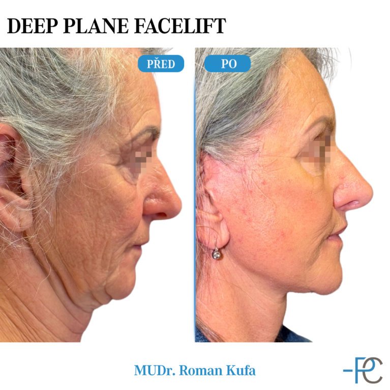 Deep Plane Facelift