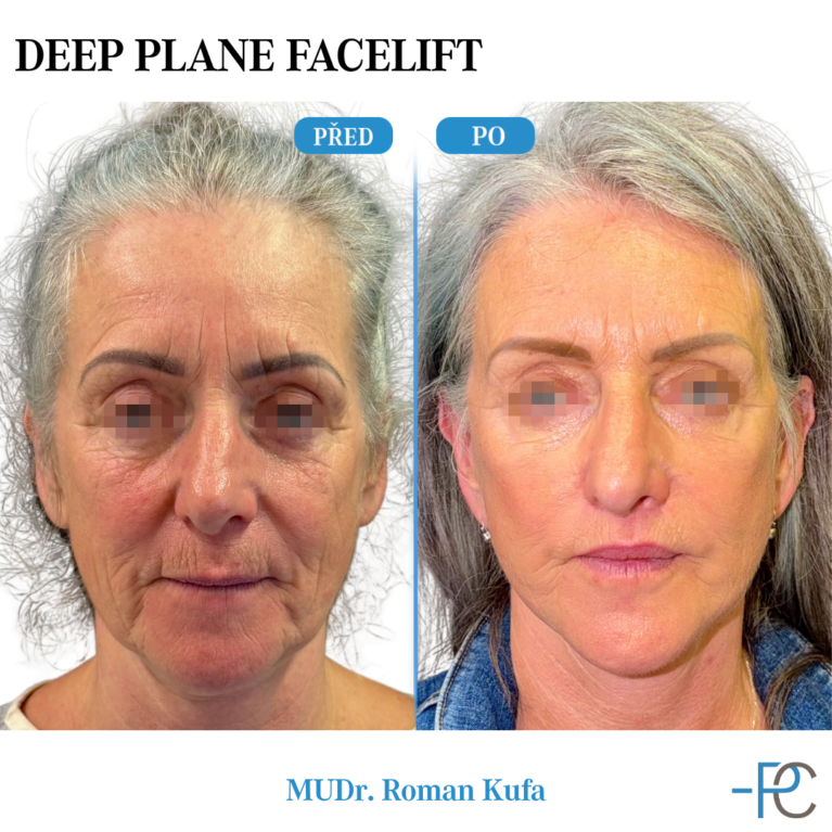 Deep Plane Facelift