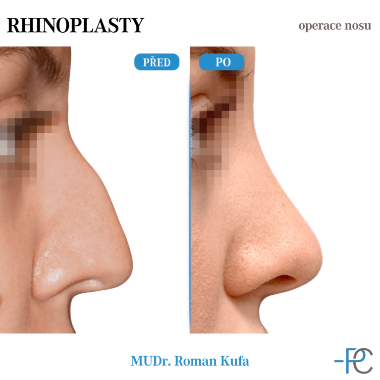 Rhinoplasty