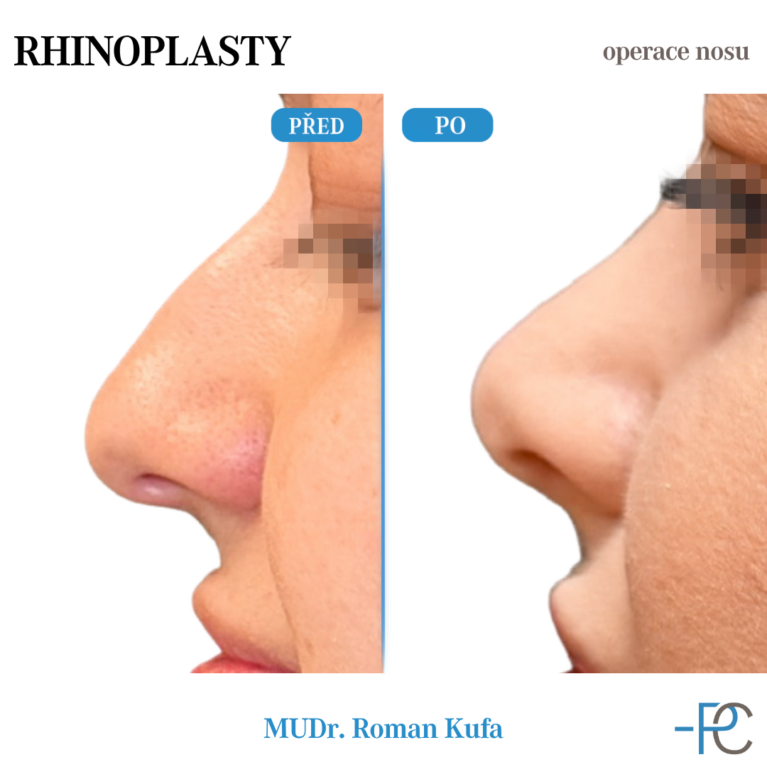 Rhinoplasty