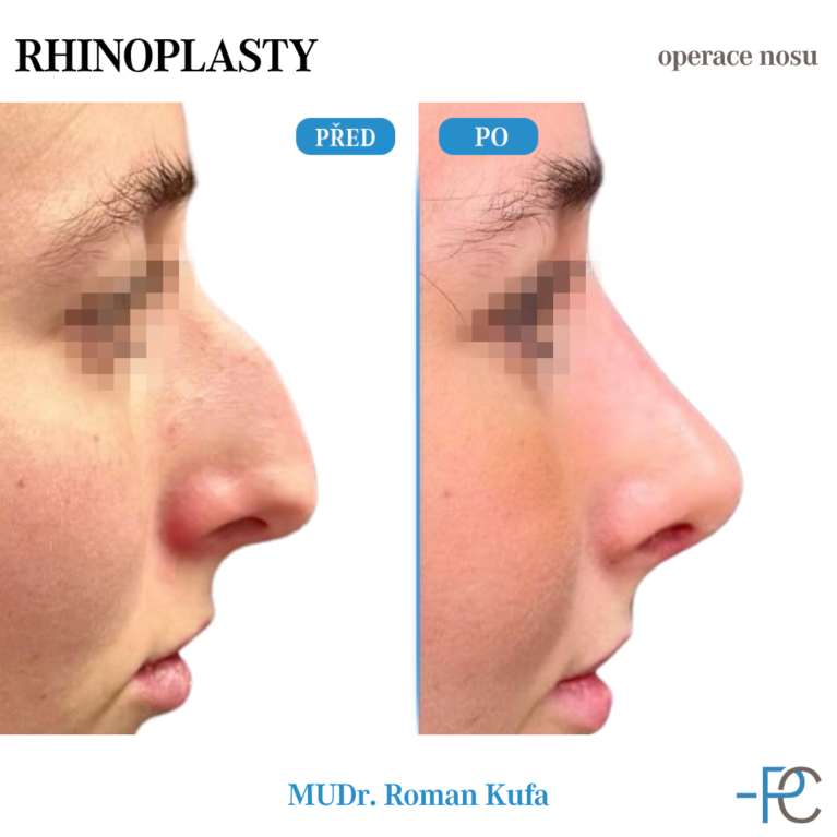 Rhinoplasty