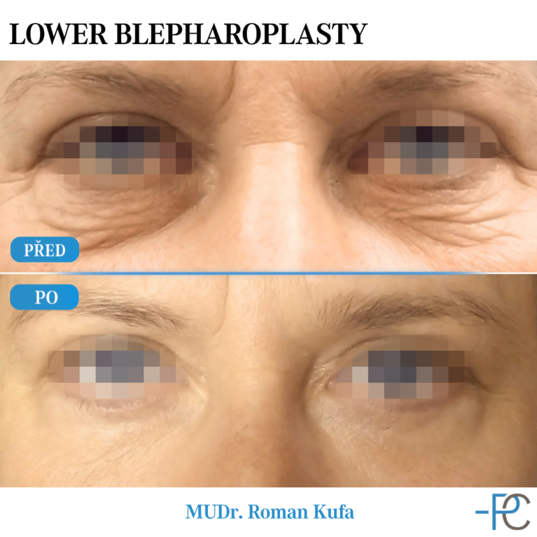 Lower eyelid surgery