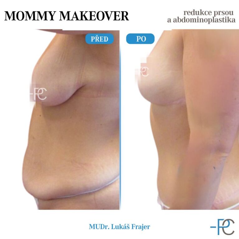 Mommy makeover