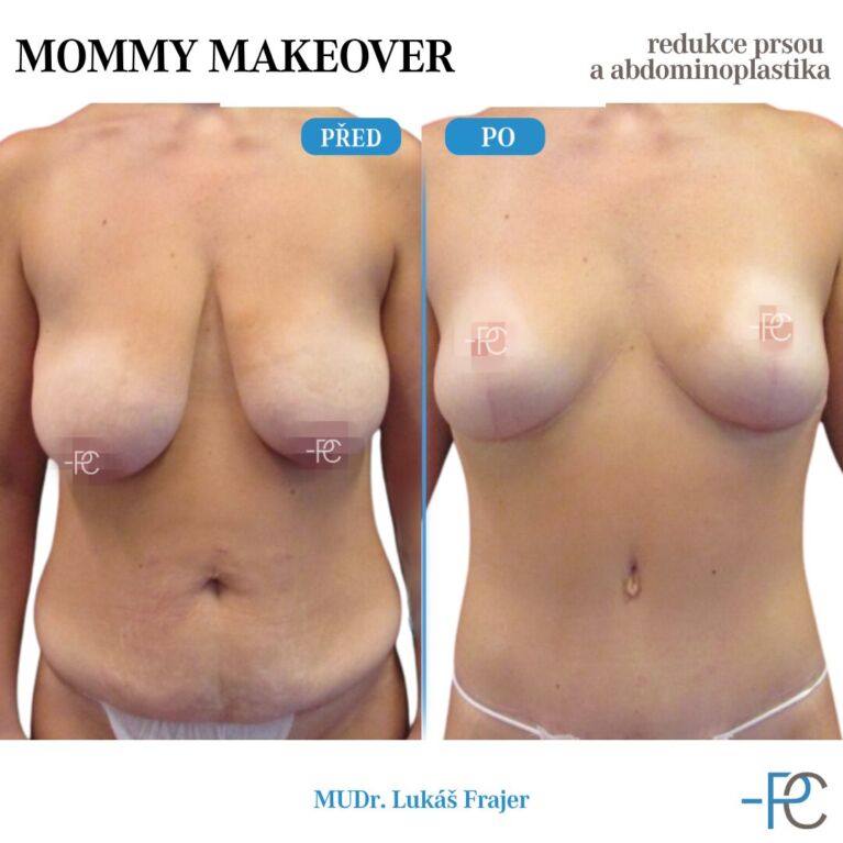 Mommy makeover