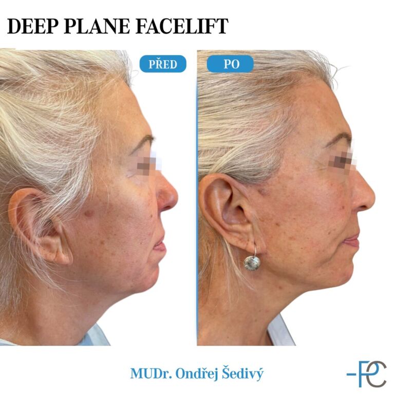 Deep Plane Facelift