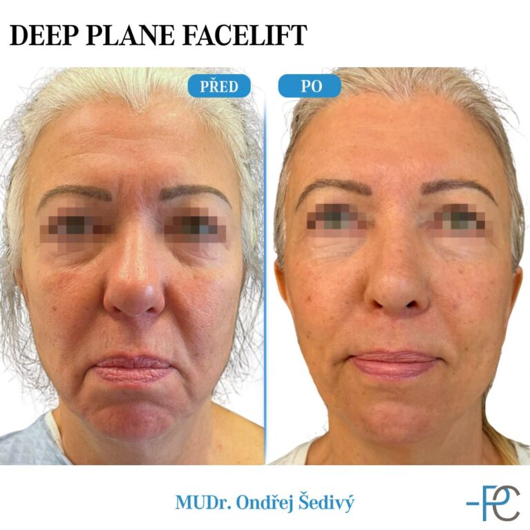 Deep Plane Facelift