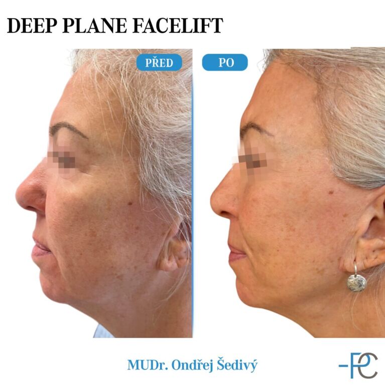 Deep Plane Facelift