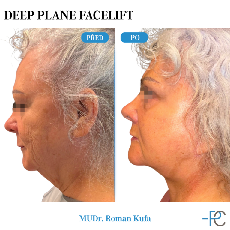 Deep Plane Facelift