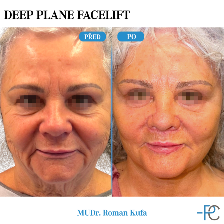 Deep Plane Facelift