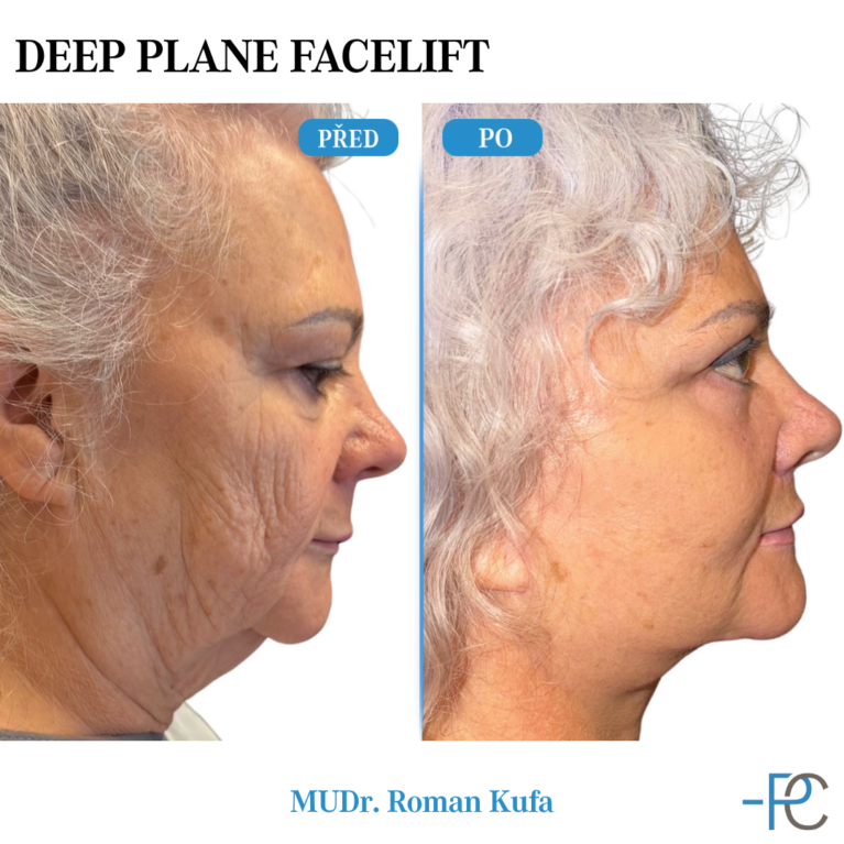 Deep Plane Facelift