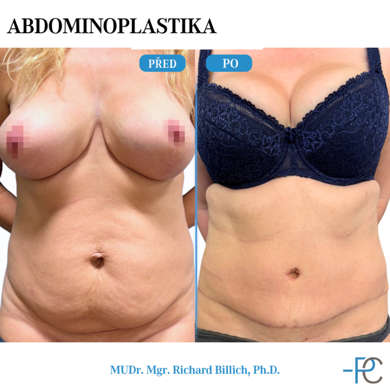 Abdominoplasty