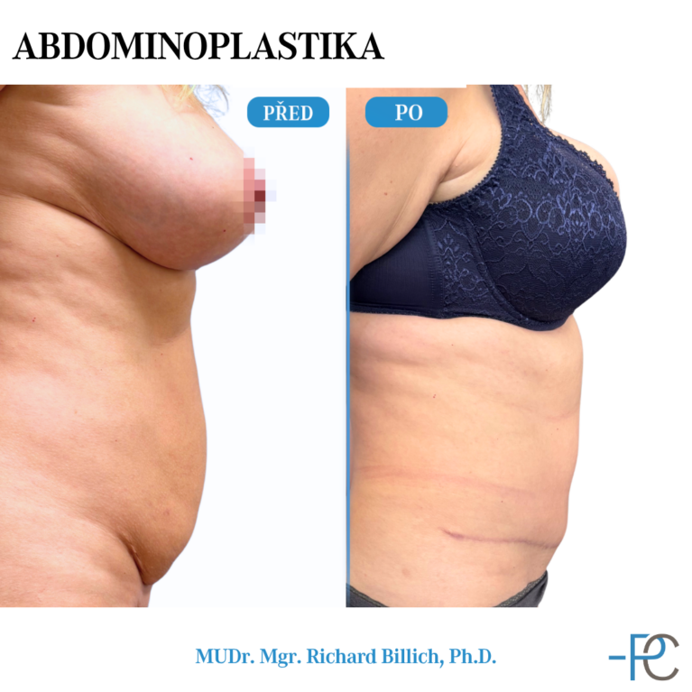 Abdominoplasty