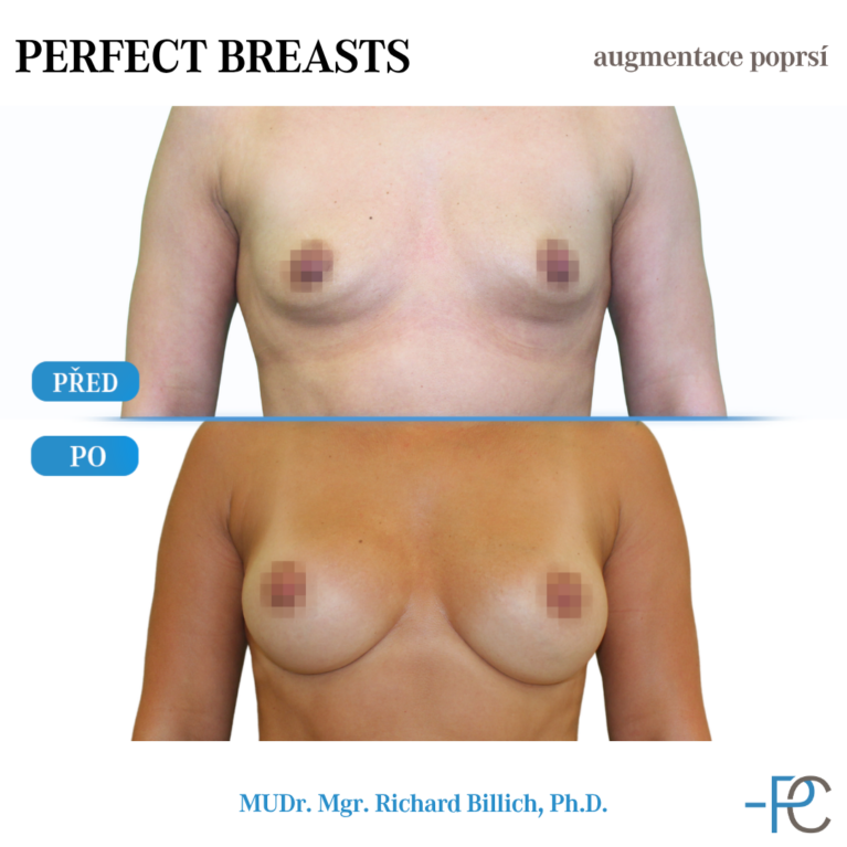 Breast augmentation