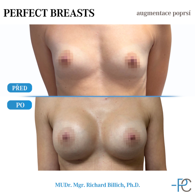 Breast augmentation