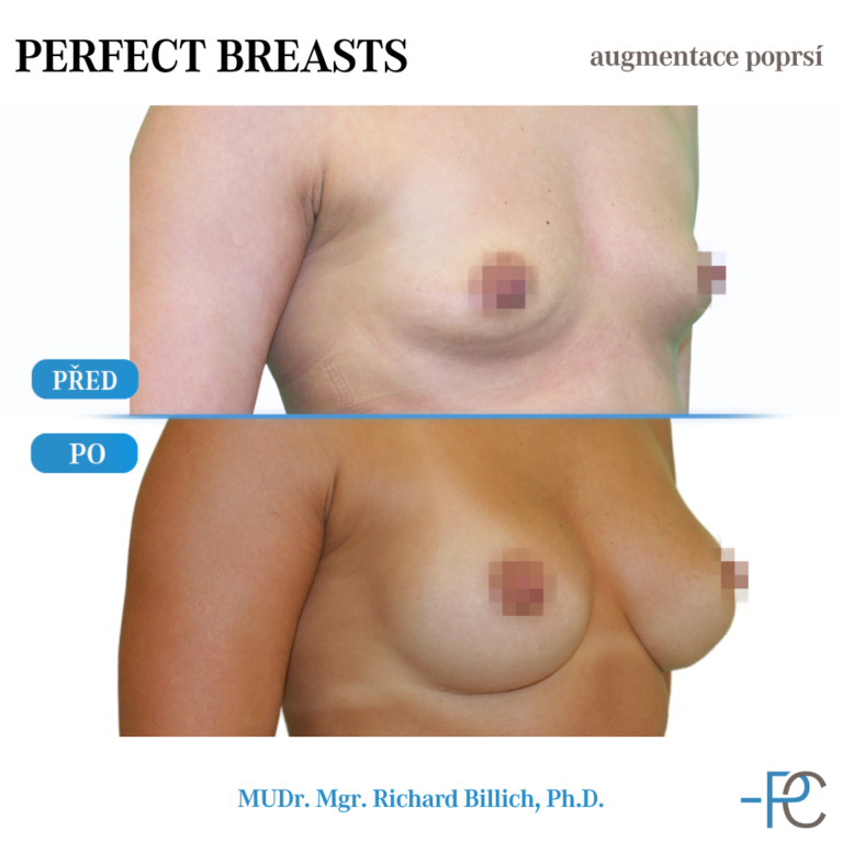 Breast augmentation