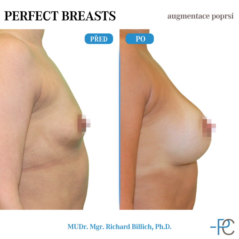 Breast augmentation