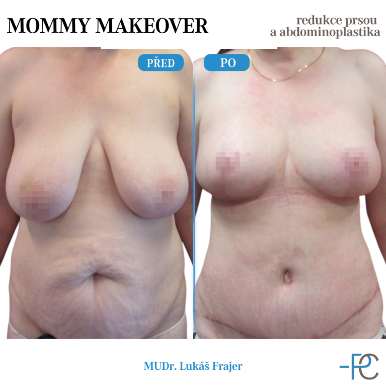 Mommy Makeover