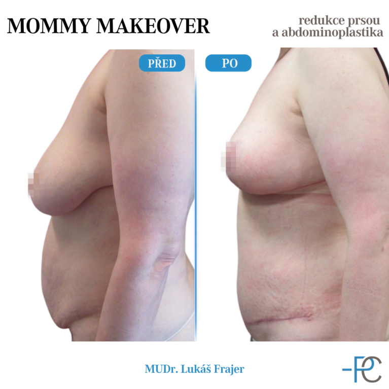 Mommy Makeover