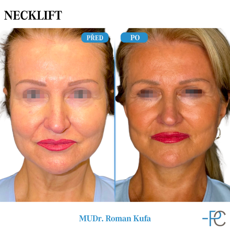 Necklift