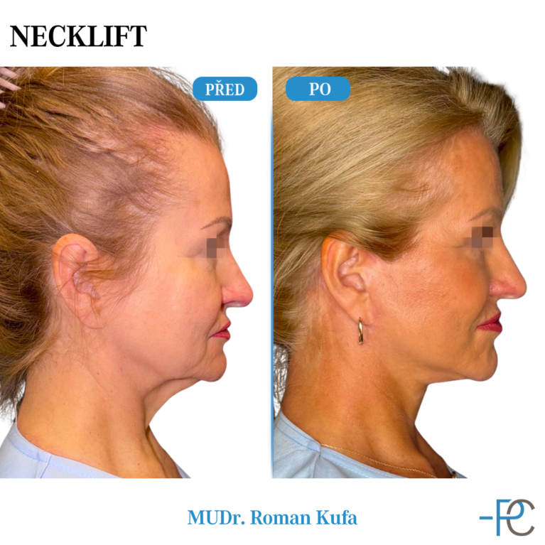 Necklift