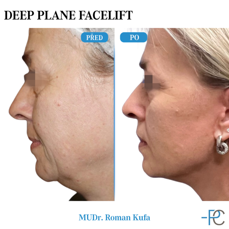 Deep Plane Facelift