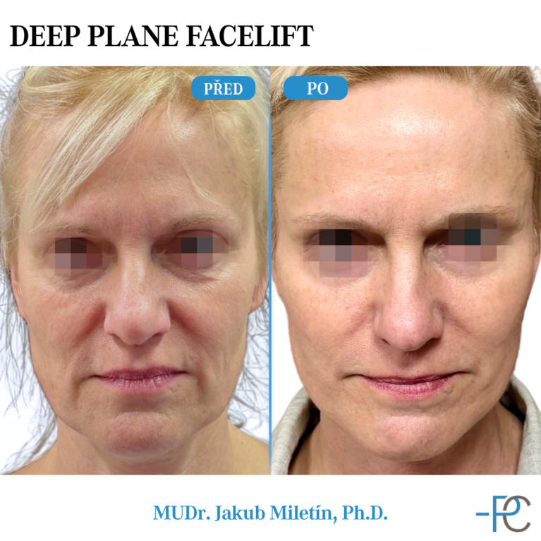 Deep Plane Facelift