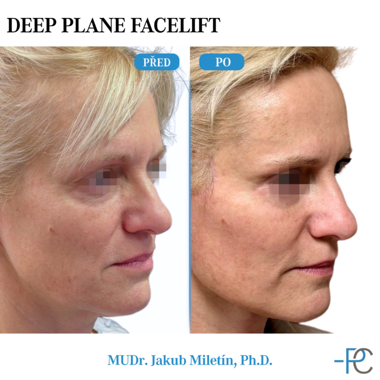 Deep Plane Facelift