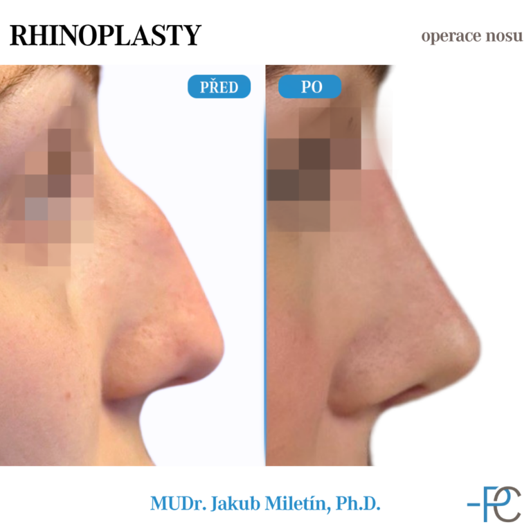 PGA Rhinoplasty