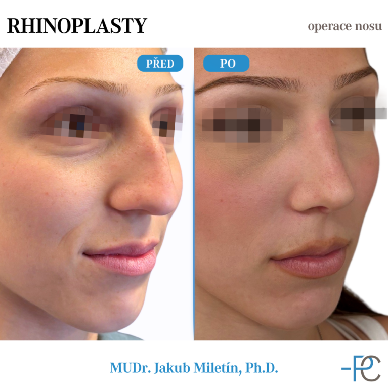 PGA Rhinoplasty