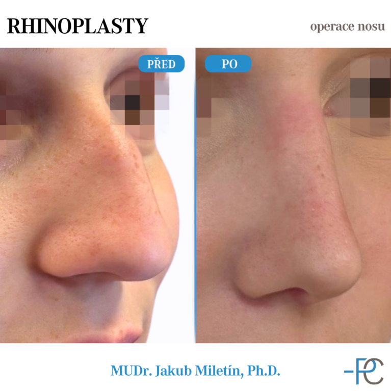 PGA Rhinoplasty