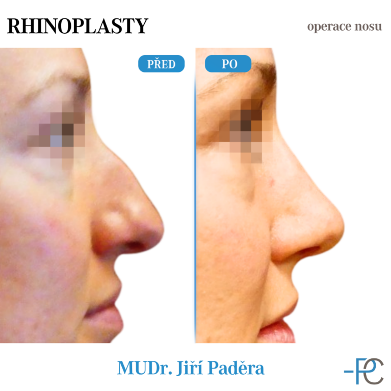 Rhinoplastika