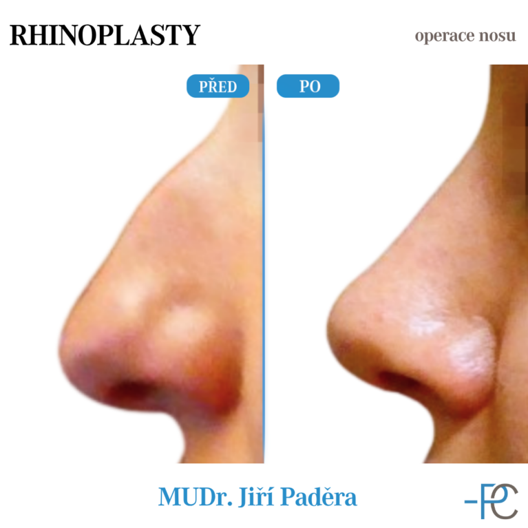 Rhinoplastika
