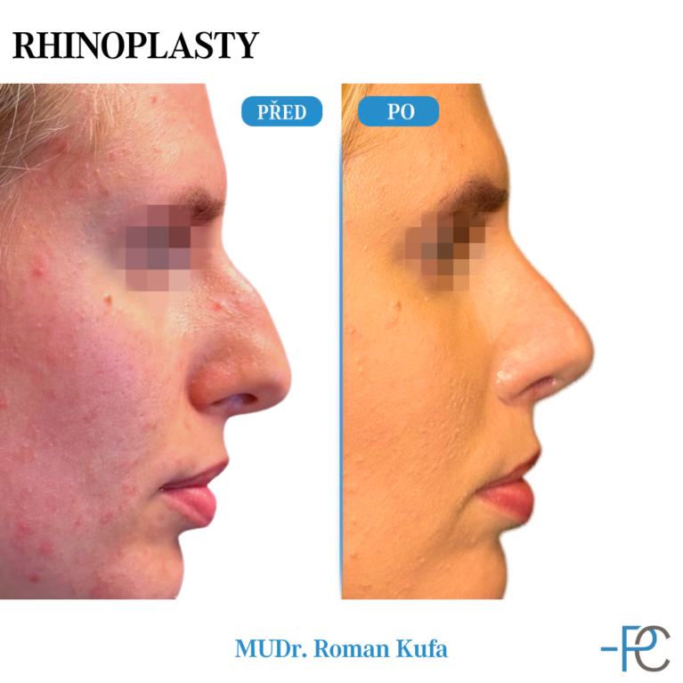 Rhinoplasty